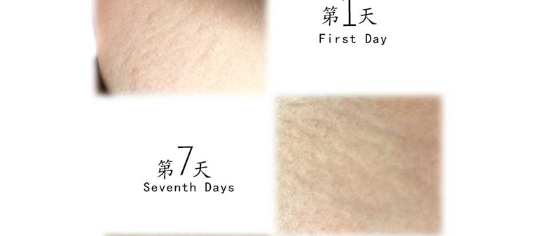 走魚(yú)妊娠紋修復套裝2_01.jpg